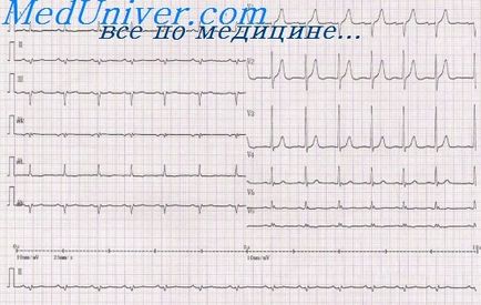 EKG körkörös apikális miokardiális infarktus