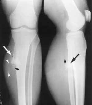 Exostosisok (osteochondróma) - tünetek és kezelés (kezelés) Exostosisok (osteochondróma) - tünetek és kezelés