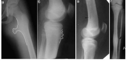 Exostosisok (osteochondróma) - tünetek és kezelés (exostosis) Exostosisok (osteochondróma) - tünetek és kezelés
