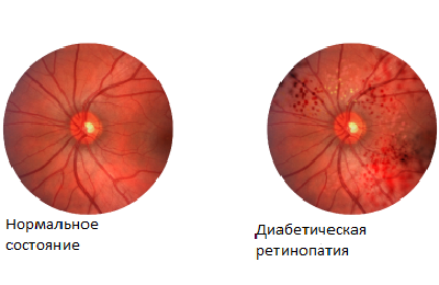 Háttér retinopathia és retinális érelváltozások, mi az, a tünetek és a kezelés (háttér) Háttér retinopathia és retinális érelváltozások, mi ez, tünetei és kezelése