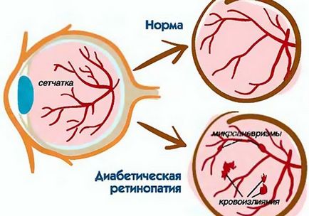 Háttér retinopathia és retinális érelváltozások, mi az, tünetek és kezelés (változás) Háttér retinopathia és retinális érelváltozások, mi ez, tünetei és kezelése