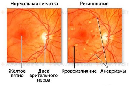 retinopathia jelentése felnőttkori cukorbetegség
