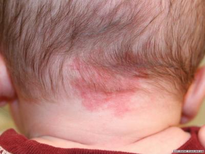 Hemangioma - okai, tünetei és kezelése és eltávolítása haemangiomáknak csecsemők