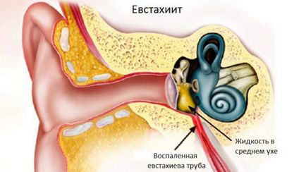 Hipertrófiás rhinitis, akut és krónikus - tünetek és a kezelés felnőttek és gyermekek számára, gyógyszerek,