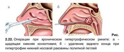 Hipertrófiás rhinitis, akut és krónikus - tünetek és a kezelés felnőttek és gyermekek számára, gyógyszerek,