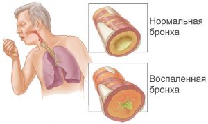 Homeopátia obstruktív bronchitis gyermekeknél és felnőtteknél