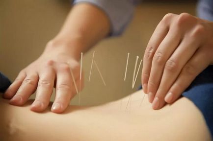 Az akupunktúra a stroke hatékonysági eljárás