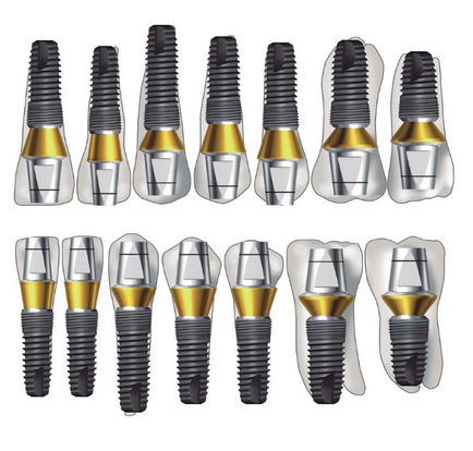 Az implantátumok implantium telepítés, funkciók, javallatok és ellenjavallatok (implantátumok) Az implantátumok implantium telepítés, funkciók, jelzések és ellenjavallatok