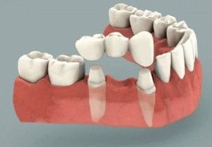 Implantátum vagy egy híd, jobb változata a fogászati ​​híd implantátum