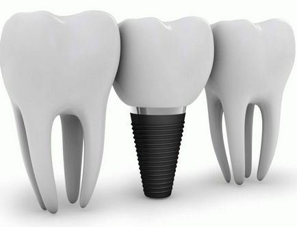 Implantátum vagy egy híd, jobb változata a fogászati ​​híd implantátum