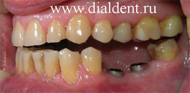 A fogászati ​​implantátumok kerül a beteg és a klinikán