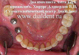 A fogászati ​​implantátumok kerül a beteg és a klinikán