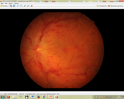 Intravitrealis injekciós ranibizumabot a IRTC „Eye Mikrosebészeti”
