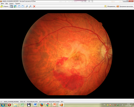 Intravitrealis injekciós ranibizumabot a IRTC „Eye Mikrosebészeti”