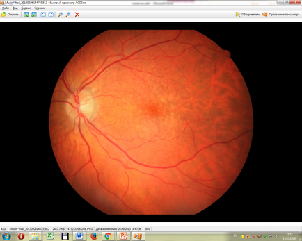 Intravitrealis injekciós ranibizumabot a IRTC „Eye Mikrosebészeti”