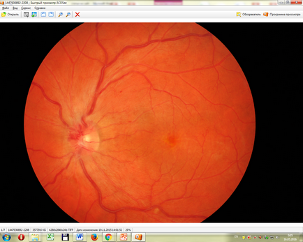 Intravitrealis injekciós ranibizumabot a IRTC „Eye Mikrosebészeti”