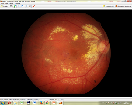 Intravitrealis injekciós ranibizumabot a IRTC „Eye Mikrosebészeti”