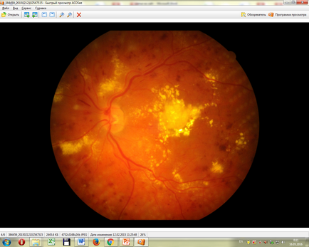 Intravitrealis injekciós ranibizumabot a IRTC „Eye Mikrosebészeti”