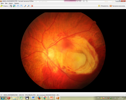 Intravitrealis injekciós ranibizumabot a IRTC „Eye Mikrosebészeti”