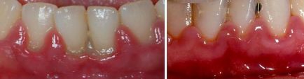 Які можуть виникнути проблеми зубів в брекетах