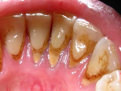 Які можуть виникнути проблеми зубів в брекетах