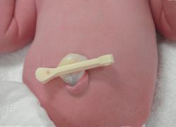 Hogyan kell kezelni egy pin köldök újszülött (újszülött) Hogyan kezeljük a köldök újszülött clothespin