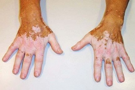 Hogyan nyerjünk vitiligo - egyszerű módszereket kezelésére vitiligo, érthető, hogy mindenki, portál esztétika (középen vitiligo) Hogyan nyerjünk vitiligo - egyszerű módszereket kezelésére vitiligo, érthető, hogy mindenki, portál esztétika