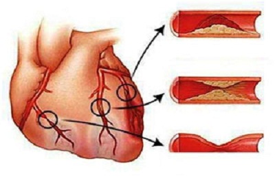 Kardiogén sokk szívinfarktus, mi ez, tünetek és elsősegély