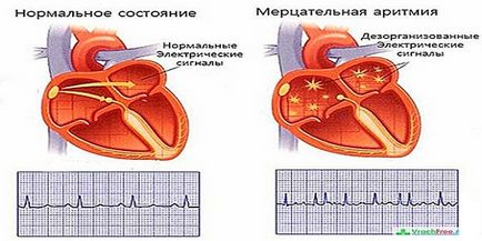 Kardiogén sokk szívinfarktus, mi ez, tünetek és elsősegély
