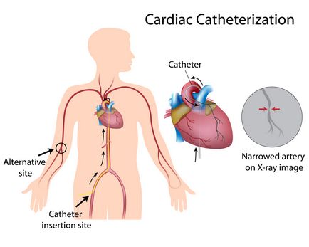 A szívkatéterezés olvasmányok, kutatási módszertan