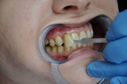 Klinikai eset komplex fogfehérítés - terápia - hírek és cikkek a fogászatban -
