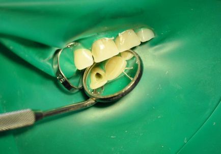 Klinikai eset komplex fogfehérítés - terápia - hírek és cikkek a fogászatban -
