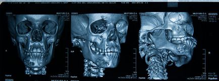 A komputertomográfia (CT), a koponya