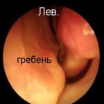 Csontfésű orr fotók, vélemények, módszerek (gerinc) Csontfésű orr fotók, vélemények, módszerek