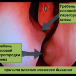 Csontfésű orr fotók, vélemények, módszerek (orr) Csontfésű orr fotók, vélemények, módszerek