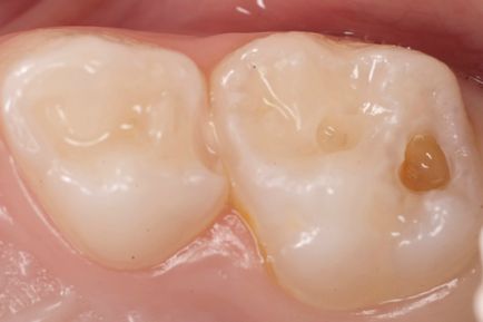 Fogszuvasodás kezelése a fogak népi jogorvoslati (caries) Fogszuvasodás kezelése a fogak népi jogorvoslati