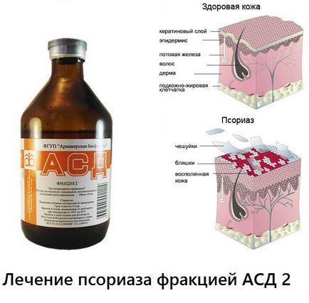 Psoriasis kezelése frakció SDA 2 - helyén a kezelések Neumyvakina orvosok Bolotov ogulova