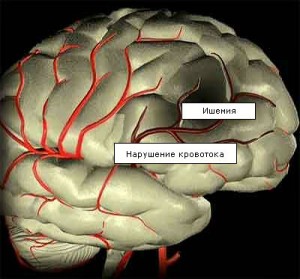 Az agyi ischaemia kezelésénél csecsemők 1, 2 és 3 fok a tünetek, jelek és hatások (agyi ischaemia) Az agyi ischaemia kezelésénél csecsemők 1, 2 és 3 fok a tünetek, jelek és következményei