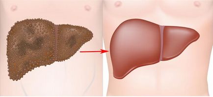 Kezelése cirrhosis népi jogorvoslati