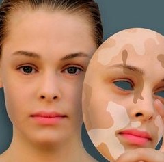 A kezelés a vitiligo lézer - hardver kozmetológiai (lézeres kezelés a vitiligo) Lézeres kezelés a vitiligo - hardver kozmetológiai