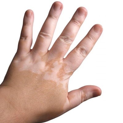 A kezelés a vitiligo megfizethető áron Moszkvában