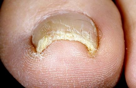megoldás a köröm gomba kezelésére bőr- és körömgombás tünetek