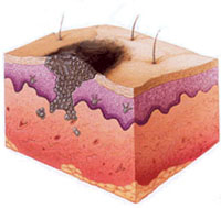 Melanoma-szerű tünetek és a felek melanoma