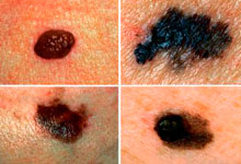 Melanoma-szerű tünetek és a felek melanoma (melanoma fényképet jelek tüneteket okoz kezelése megelőzésére) Melanoma-szerű tünetek és a felek melanoma