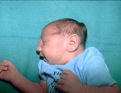 Microcephalia gyermekeknél a tünetek, okok, diagnózis a magzat és az újszülött, az abc az egészségügyi