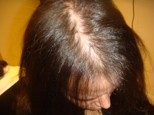 Lehet festeni a hajam kemoterápia után