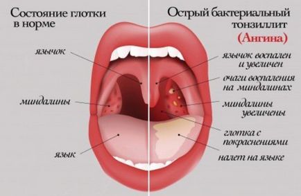 Lehetséges, hogy gyógyítani a torokfájás, antibiotikumok nélkül, follikuláris, kéknyelv (kúra) Lehetséges, hogy gyógyítani a torokfájás, antibiotikumok nélkül, follikuláris, kéknyelv