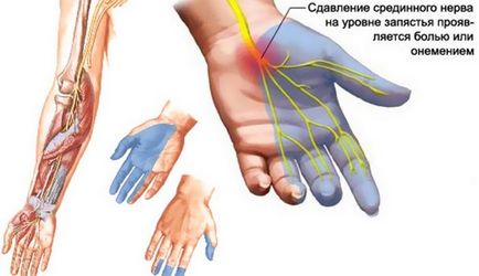 Neuropátia alakul mindkét típusú, a tünetek és a kezelés (kezelés) Neuropátia alakul mindkét típusú, a tünetek és a kezelés