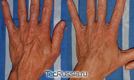 Kézi fiatalítás - hogyan távolítsa el a ráncokat, öregségi foltok és kiálló vénák a kézen