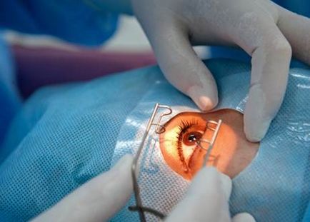 Látás 3 5 dioptriában, Lézeres szemműtét